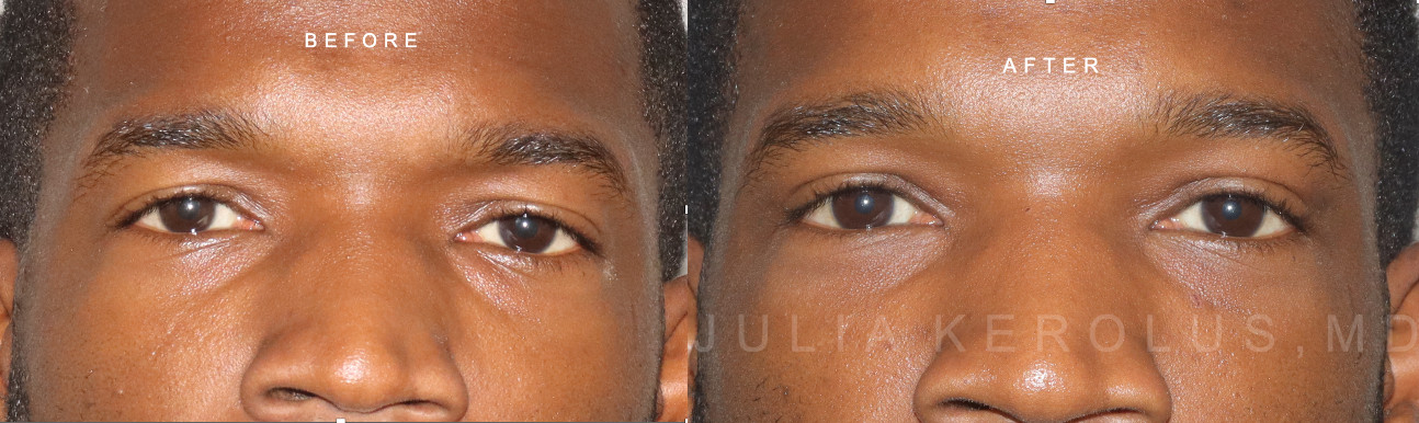 Browlift/Blepharoplasty Before & After Image