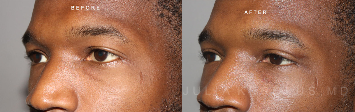 Browlift/Blepharoplasty Before & After Image