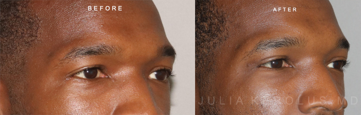 Browlift/Blepharoplasty Before & After Image