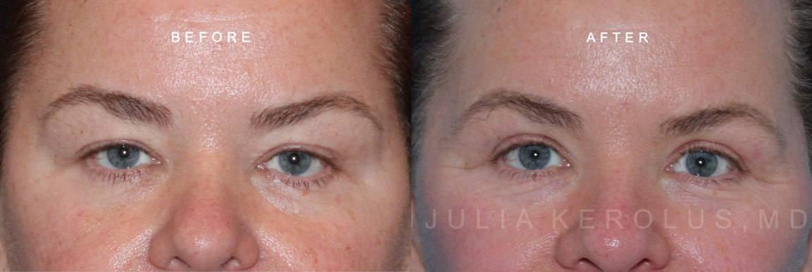 Browlift/Blepharoplasty Before & After Image