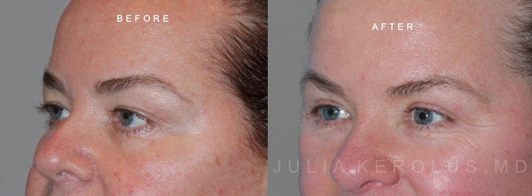 Browlift/Blepharoplasty Before & After Image