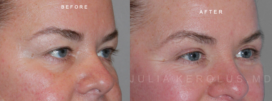 Browlift/Blepharoplasty Before & After Image