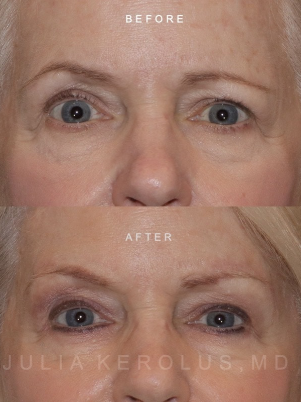 Browlift/Blepharoplasty Before & After Image