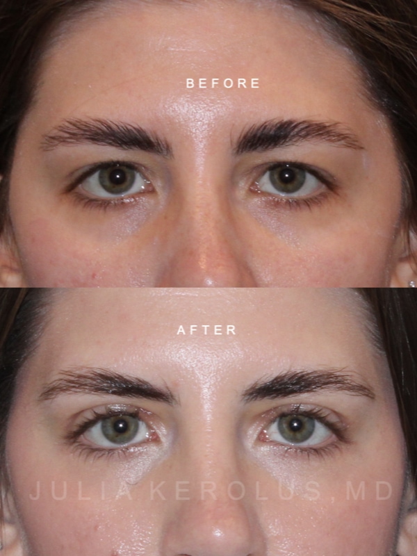 Browlift/Blepharoplasty Before & After Image