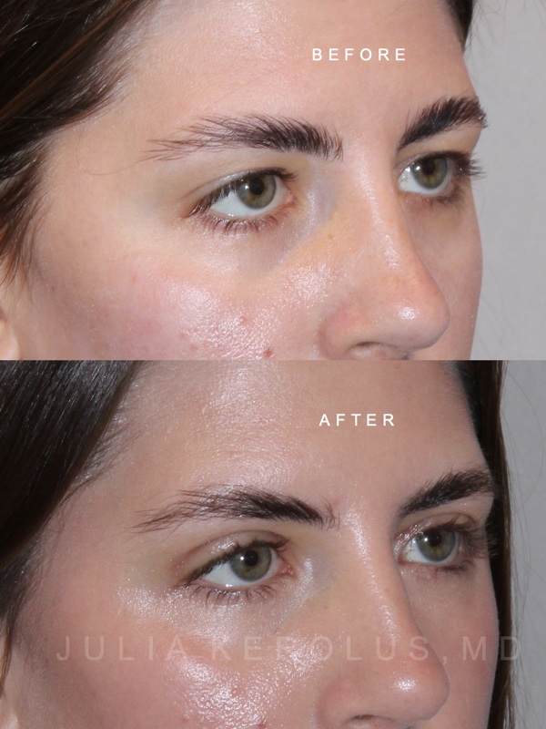 Browlift/Blepharoplasty Before & After Image