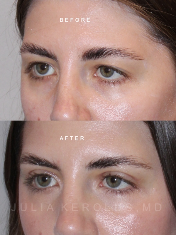 Browlift/Blepharoplasty Before & After Image