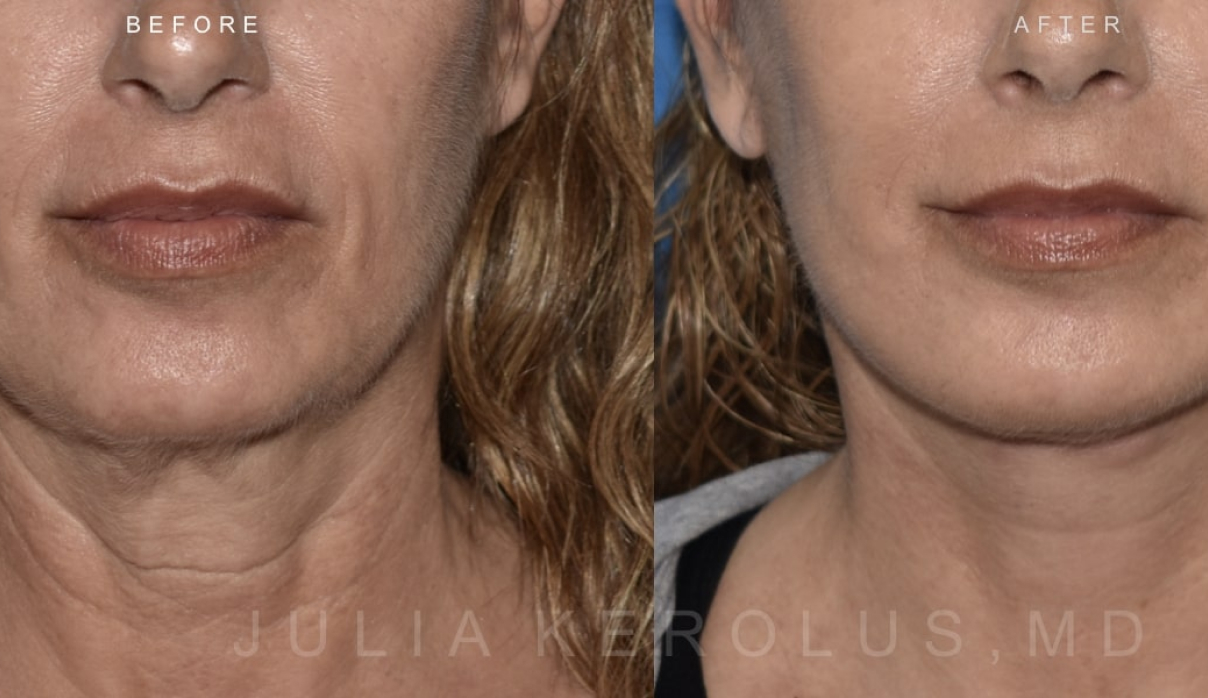 Deep Plane Facelift/Neck Lift Before & After Image