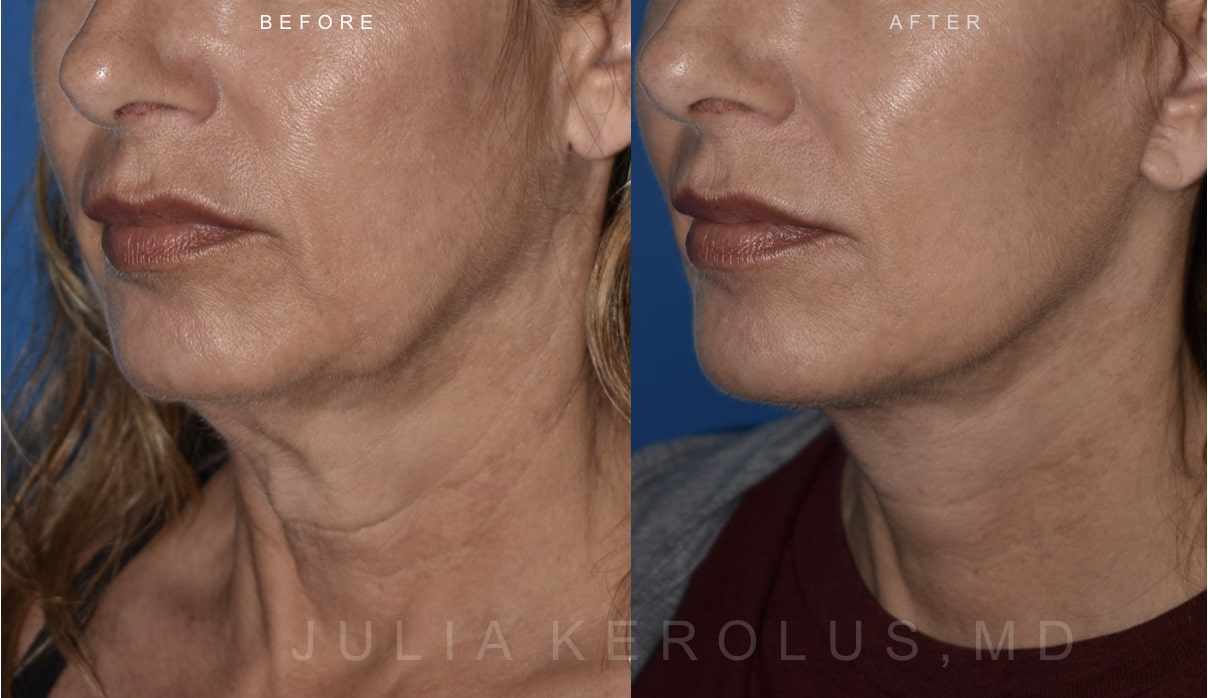 Deep Plane Facelift/Neck Lift Before & After Image