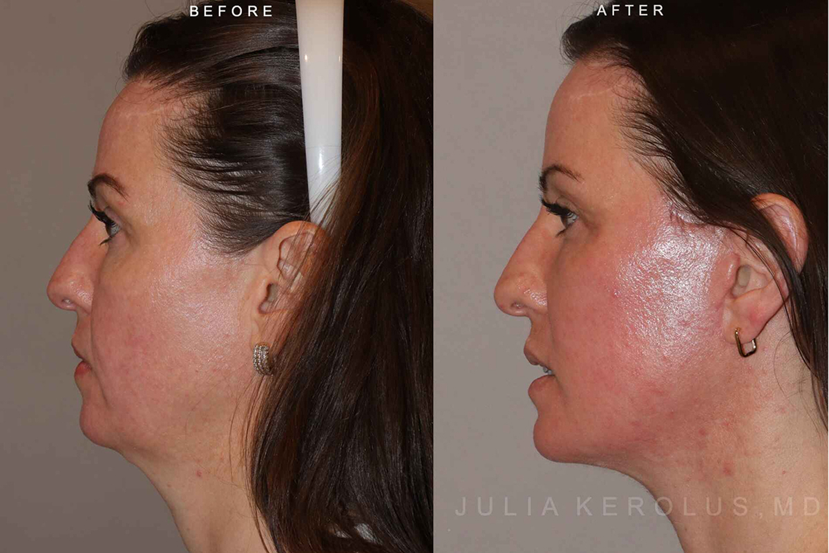 Deep Plane Facelift/Neck Lift Before & After Image