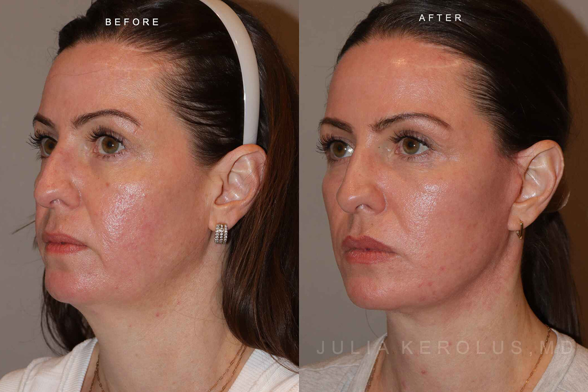 Deep Plane Facelift/Neck Lift Before & After Image