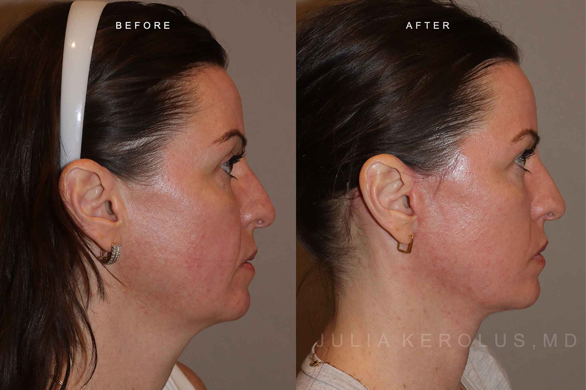 Deep Plane Facelift/Neck Lift Before & After Image