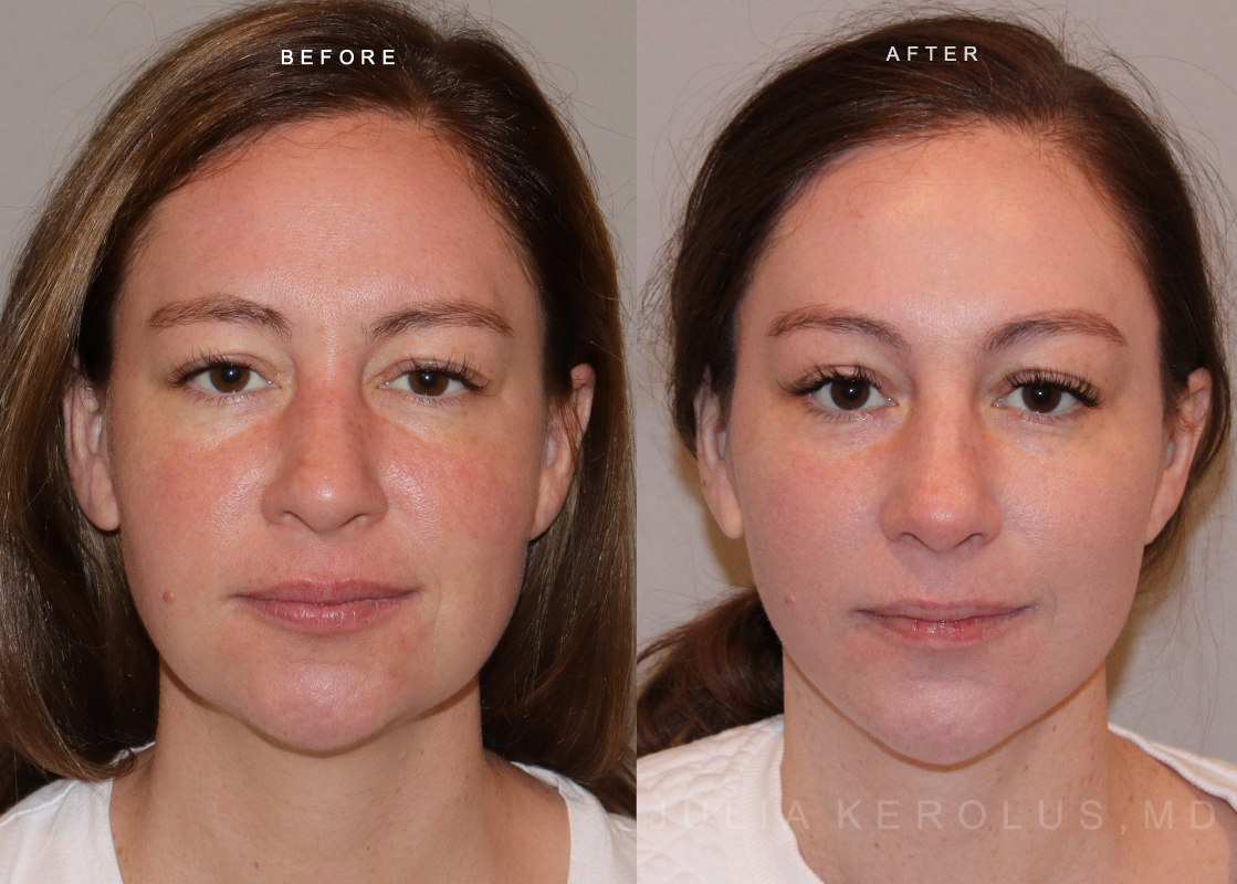 Deep Plane Facelift/Neck Lift Before & After Image