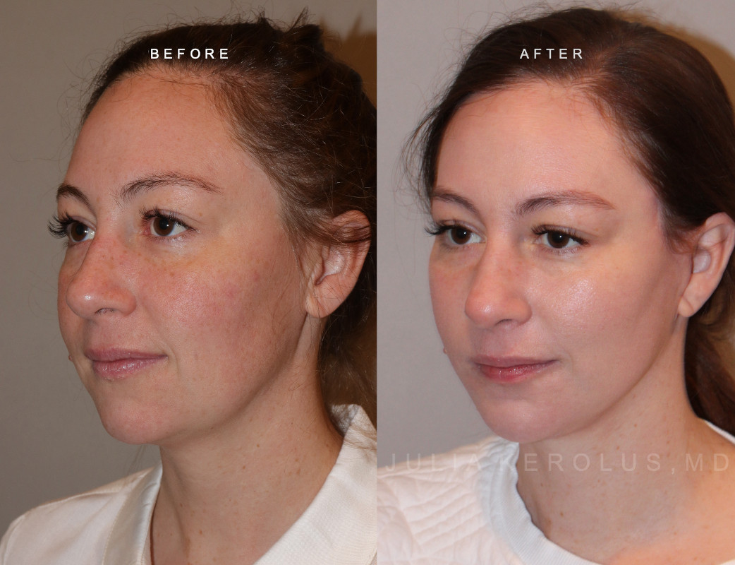 Deep Plane Facelift/Neck Lift Before & After Image