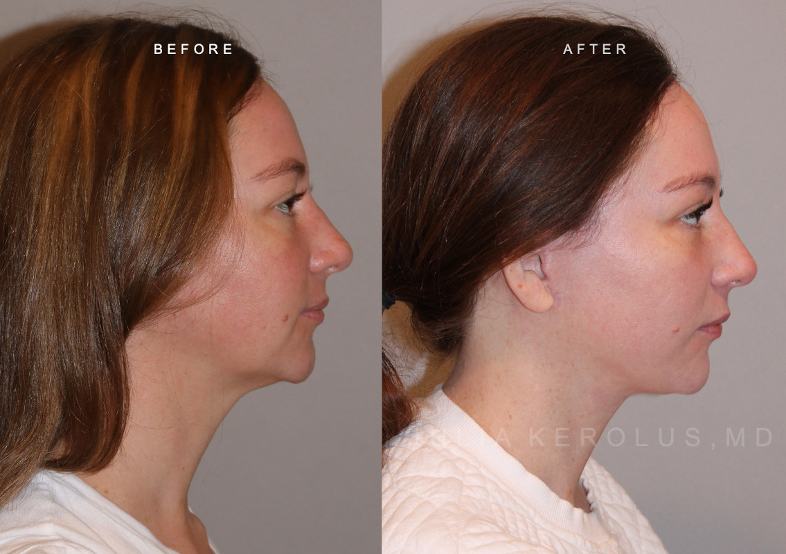 Deep Plane Facelift/Neck Lift Before & After Image