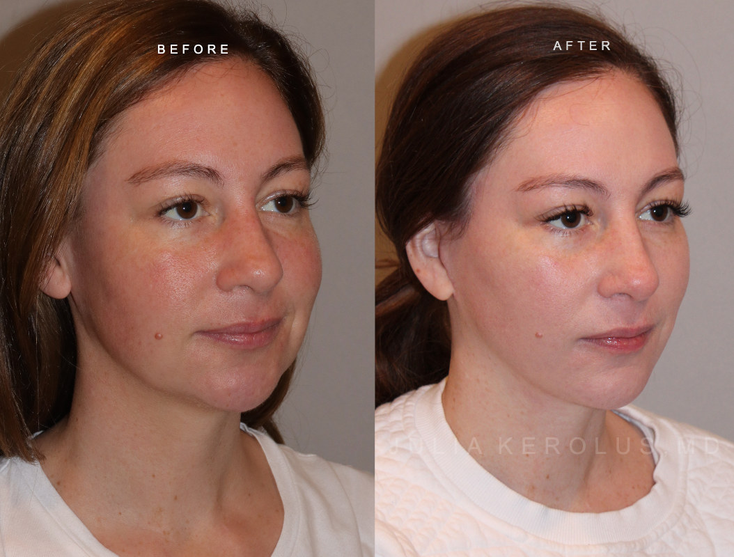 Deep Plane Facelift/Neck Lift Before & After Image