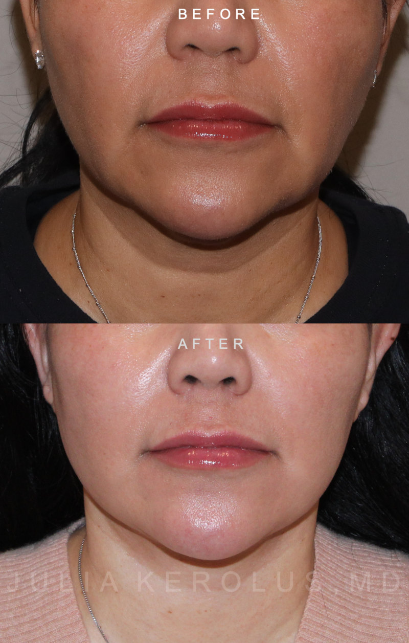 Deep Plane Facelift/Neck Lift Before & After Image