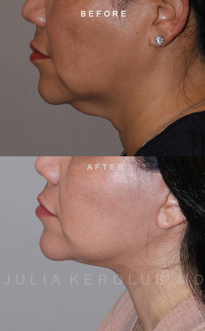 Deep Plane Facelift/Neck Lift Before & After Image