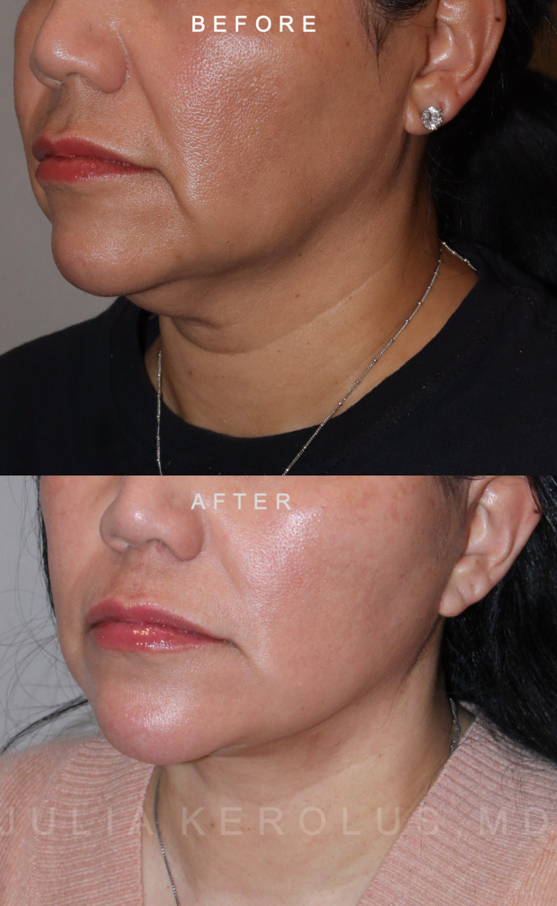 Deep Plane Facelift/Neck Lift Before & After Image