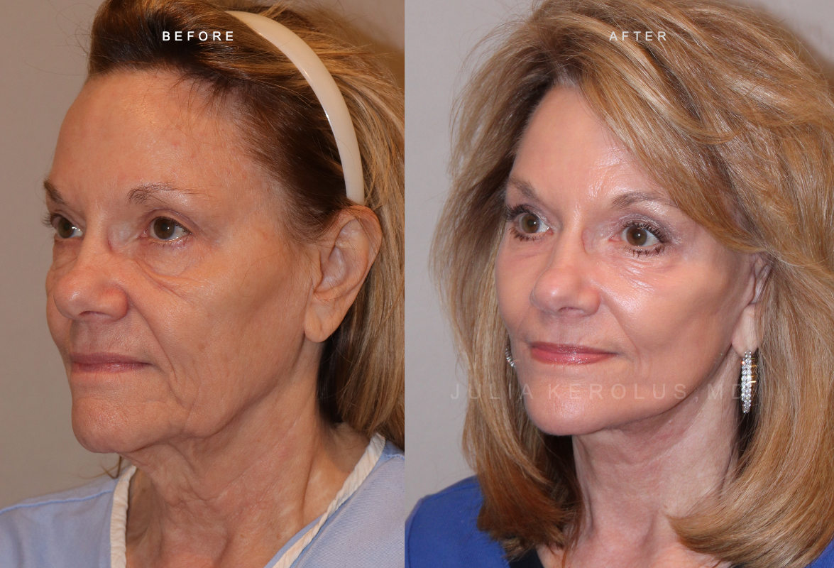 Deep Plane Facelift/Neck Lift Before & After Image