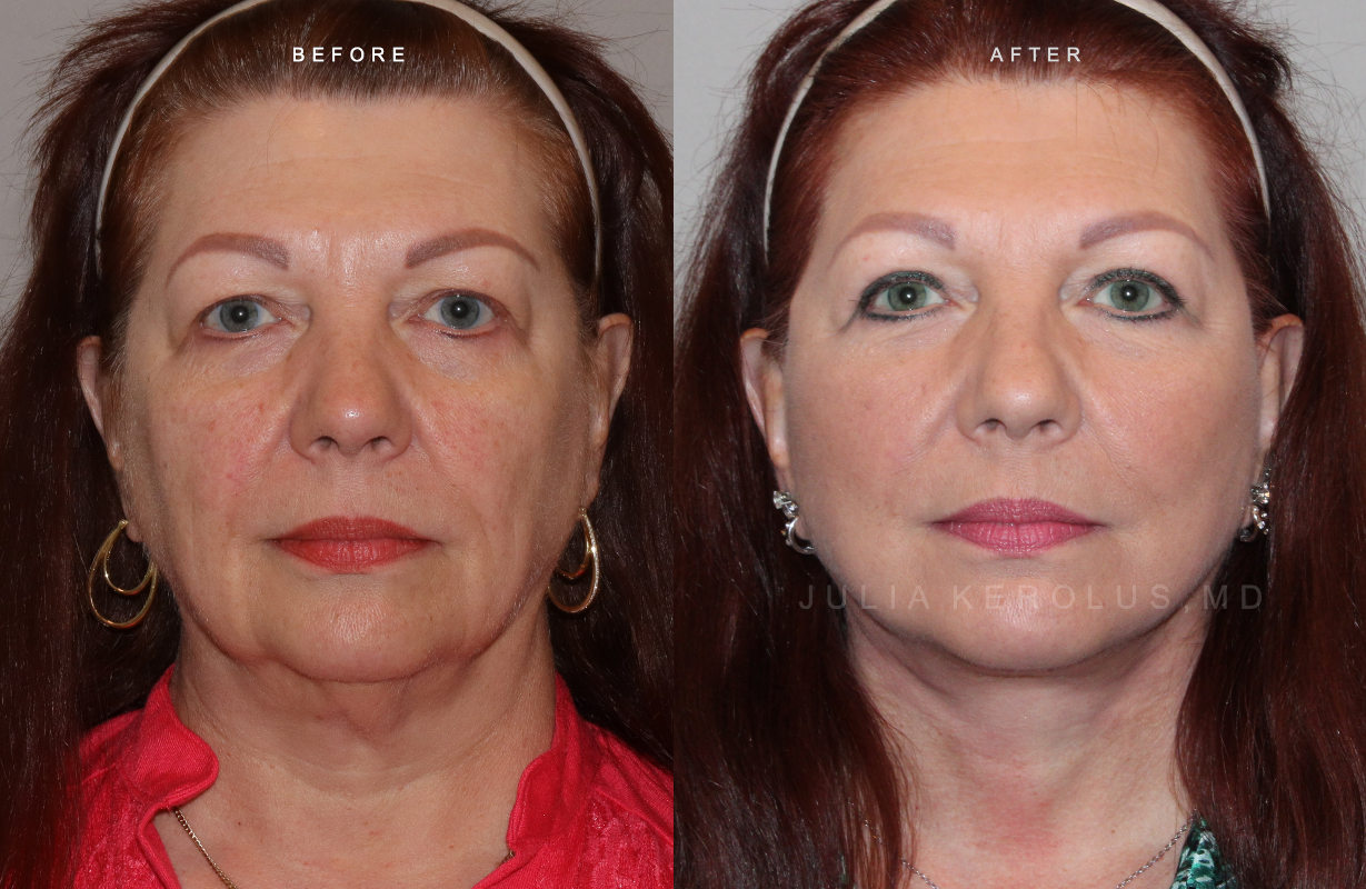 Deep Plane Facelift/Neck Lift Before & After Image