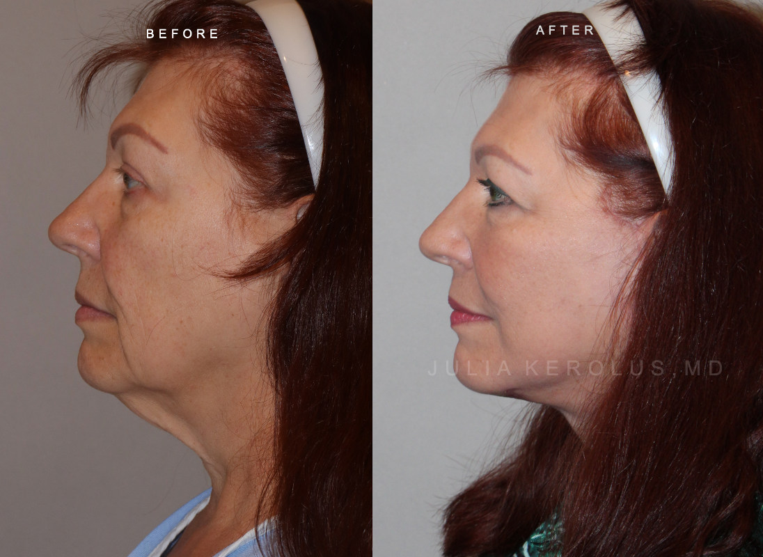 Deep Plane Facelift/Neck Lift Before & After Image