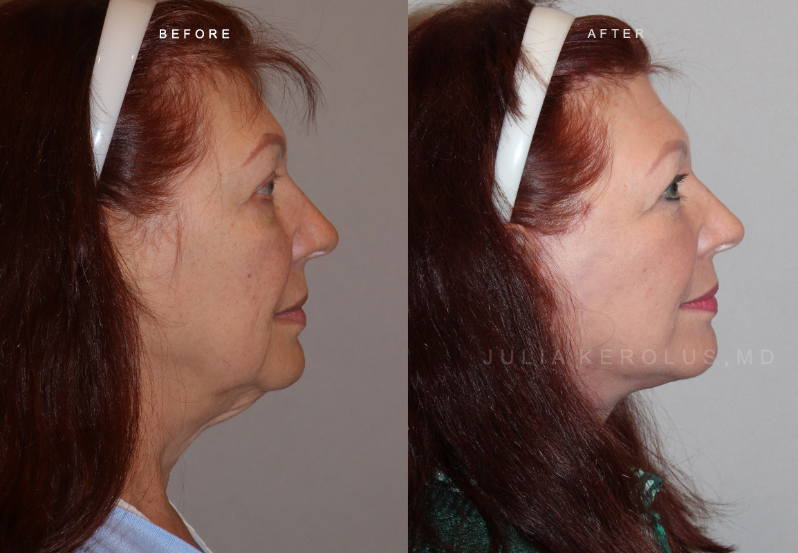 Deep Plane Facelift/Neck Lift Before & After Image