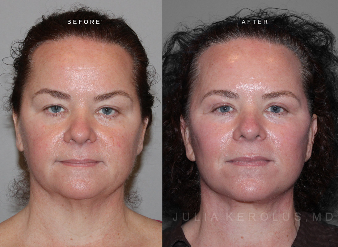 Deep Plane Facelift/Neck Lift Before & After Image