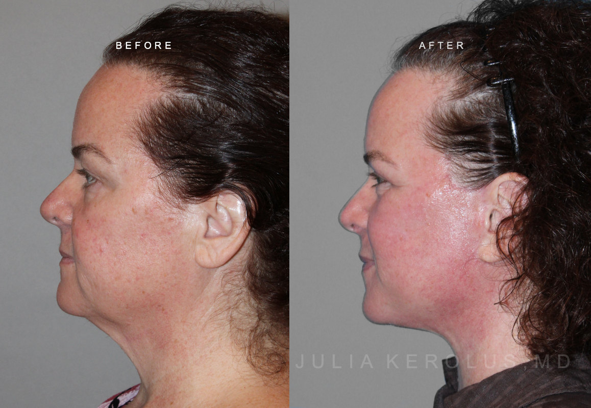 Deep Plane Facelift/Neck Lift Before & After Image