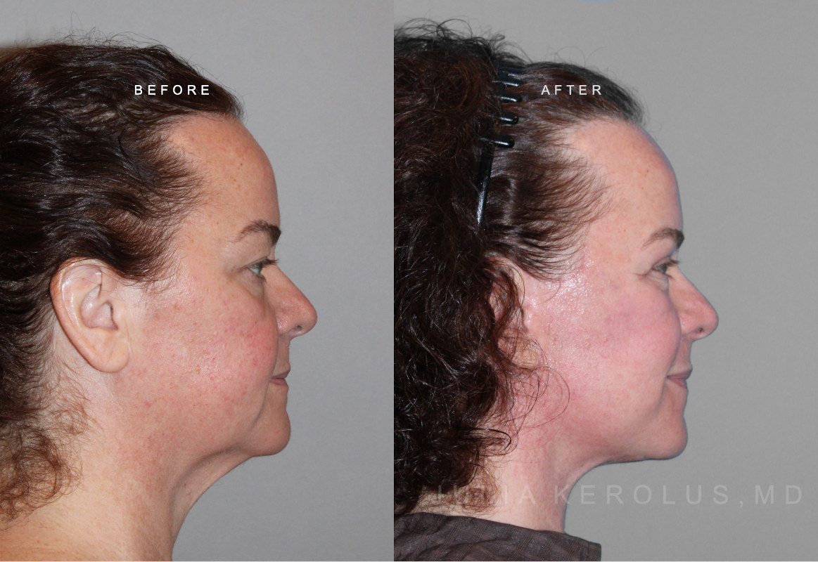 Deep Plane Facelift/Neck Lift Before & After Image