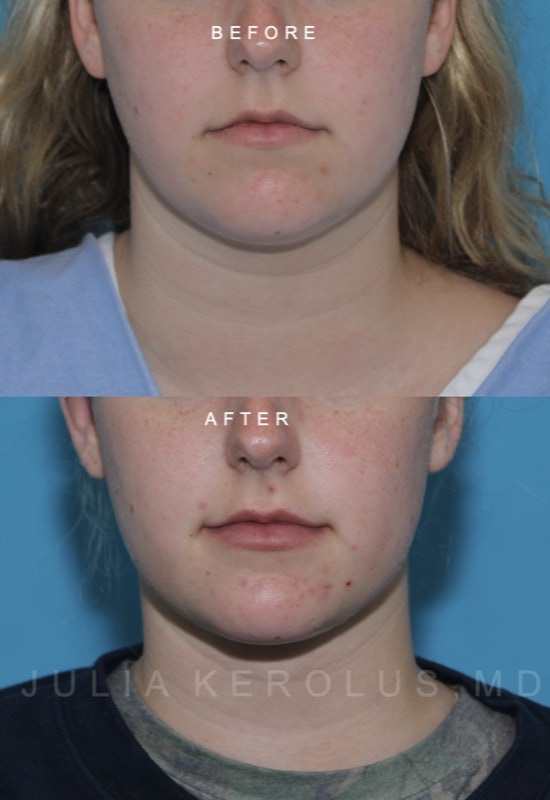 Deep Plane Facelift/Neck Lift Before & After Image