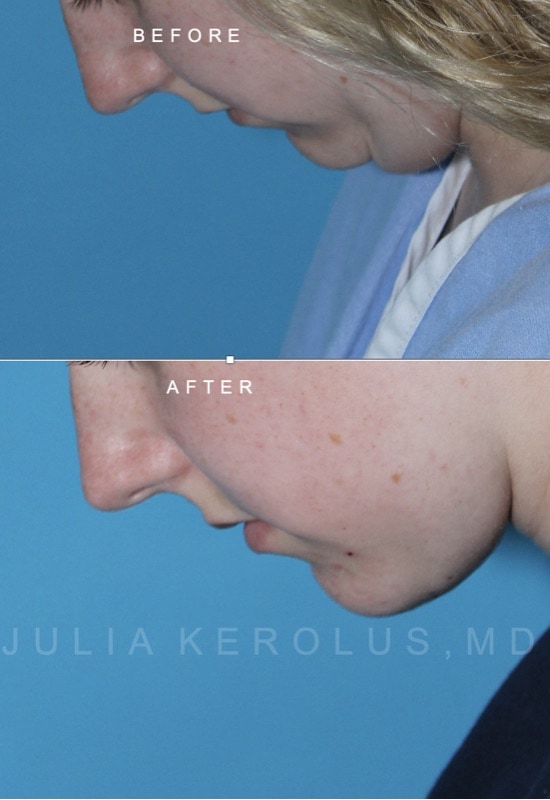 Deep Plane Facelift/Neck Lift Before & After Image