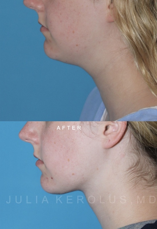 Deep Plane Facelift/Neck Lift Before & After Image