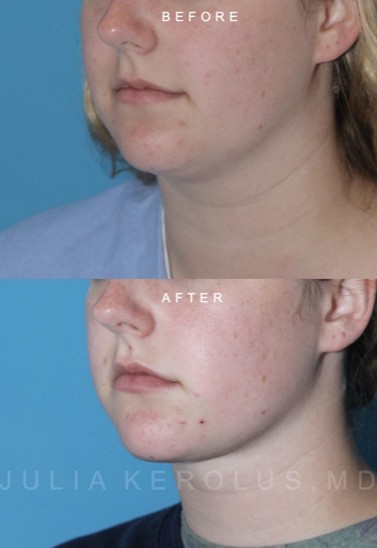Deep Plane Facelift/Neck Lift Before & After Image