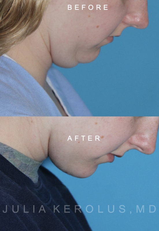 Deep Plane Facelift/Neck Lift Before & After Image