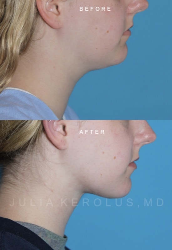 Deep Plane Facelift/Neck Lift Before & After Image