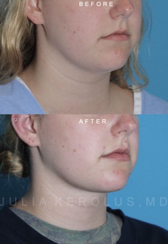 Deep Plane Facelift/Neck Lift Before & After Image