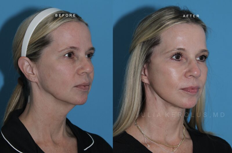 Deep Plane Facelift/Neck Lift Before & After Image