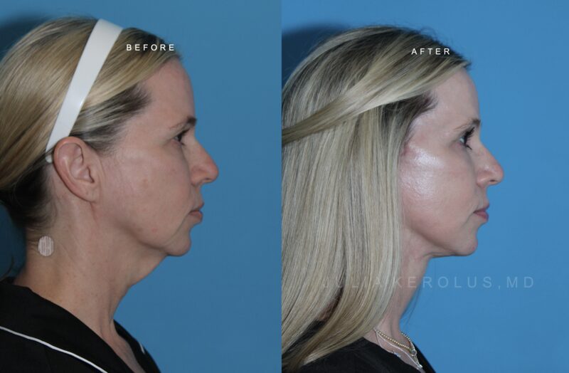 Deep Plane Facelift/Neck Lift Before & After Image
