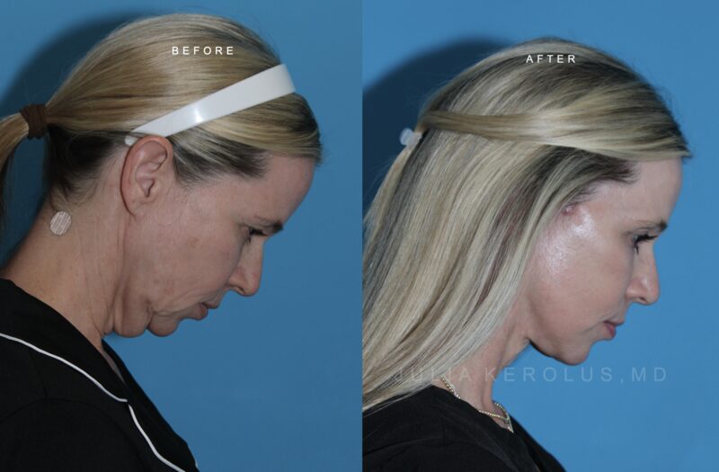 Deep Plane Facelift/Neck Lift Before & After Image