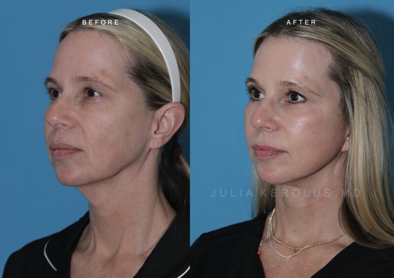 Deep Plane Facelift/Neck Lift Before & After Image