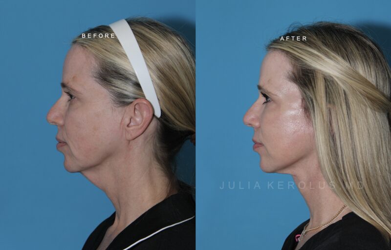 Deep Plane Facelift/Neck Lift Before & After Image