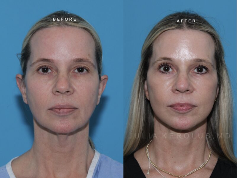 Deep Plane Facelift/Neck Lift Before & After Image