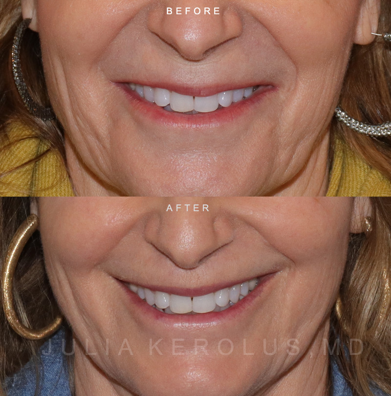 Lip Lift Before & After Image