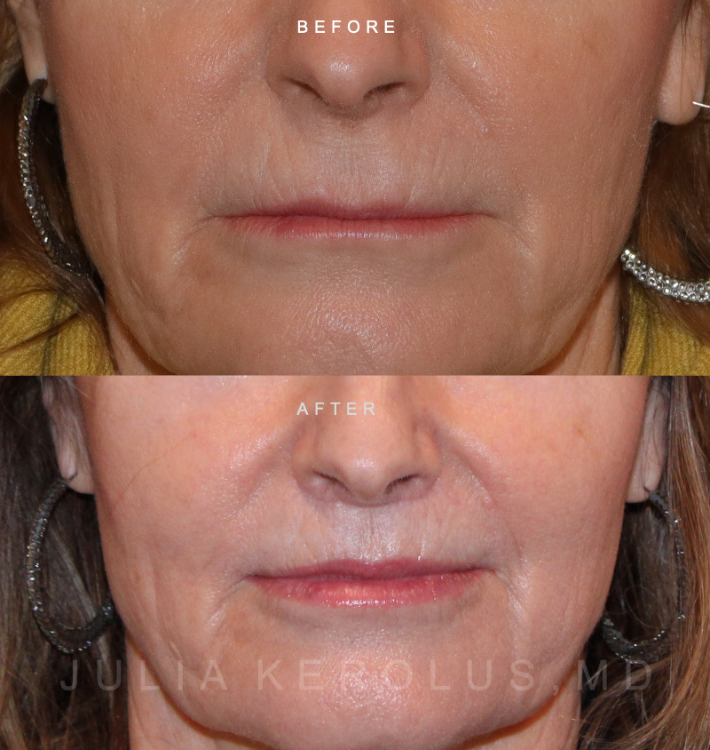 Lip Lift Before & After Image