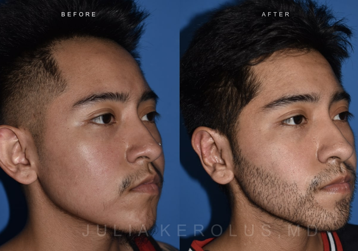 Facial Contouring Before & After Image