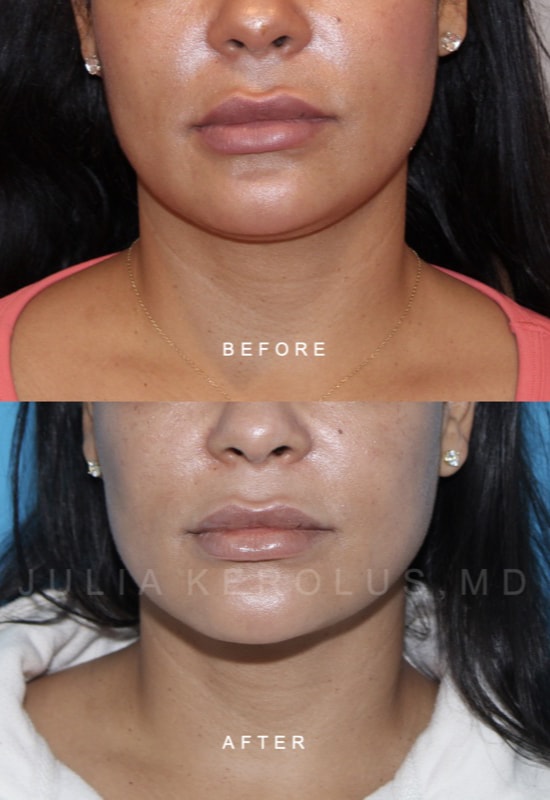 Facial Contouring Before & After Image