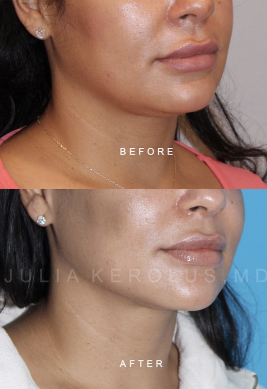 Facial Contouring Before & After Image