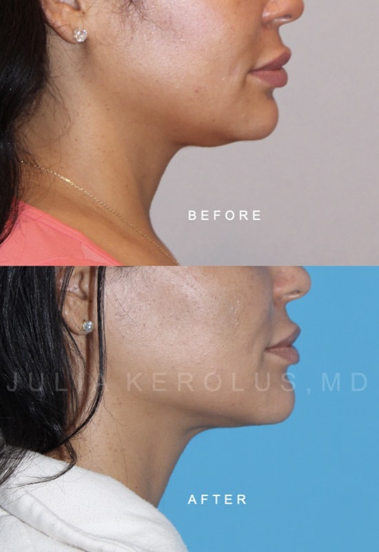 Facial Contouring Before & After Image