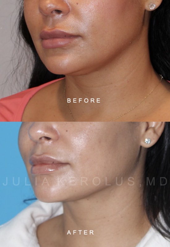 Facial Contouring Before & After Image