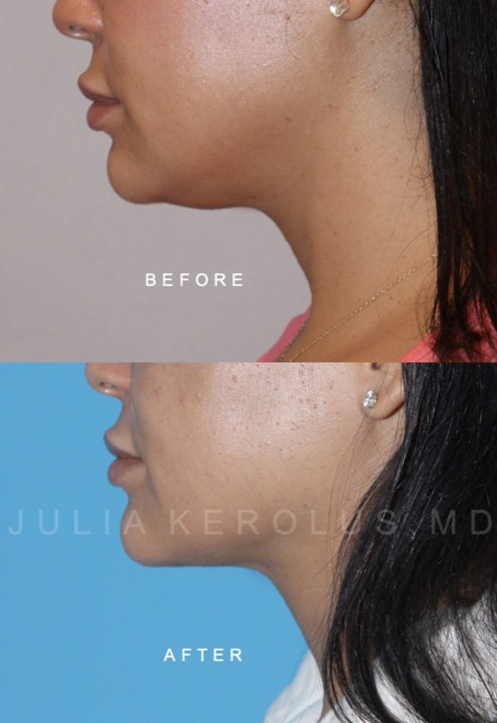 Facial Contouring Before & After Image